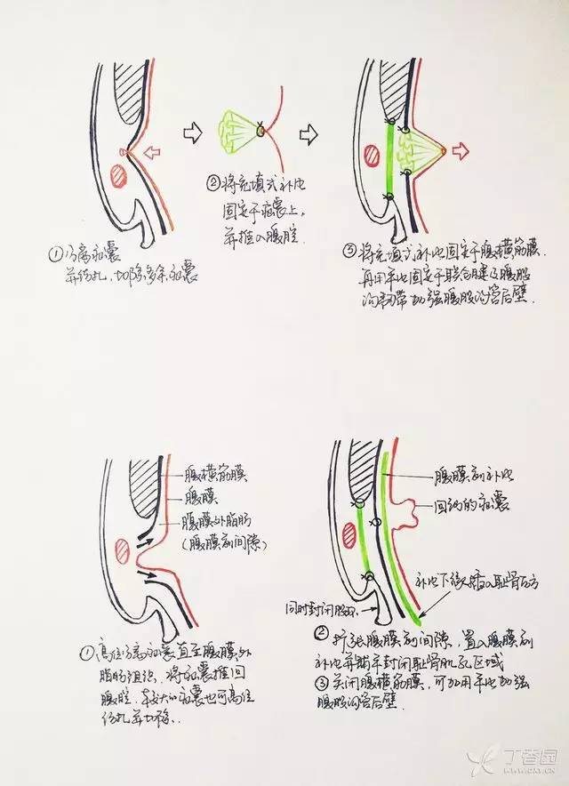 全國(guó)疝氣治療技術(shù)的革新與進(jìn)步，最新治療技術(shù)探索與力量展示